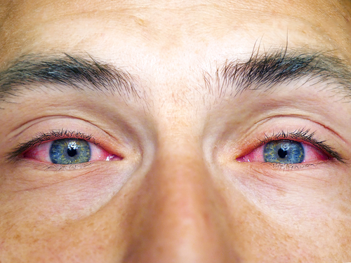 Methamphetamine eyes are typically characterized by several key factors, the most common of these being