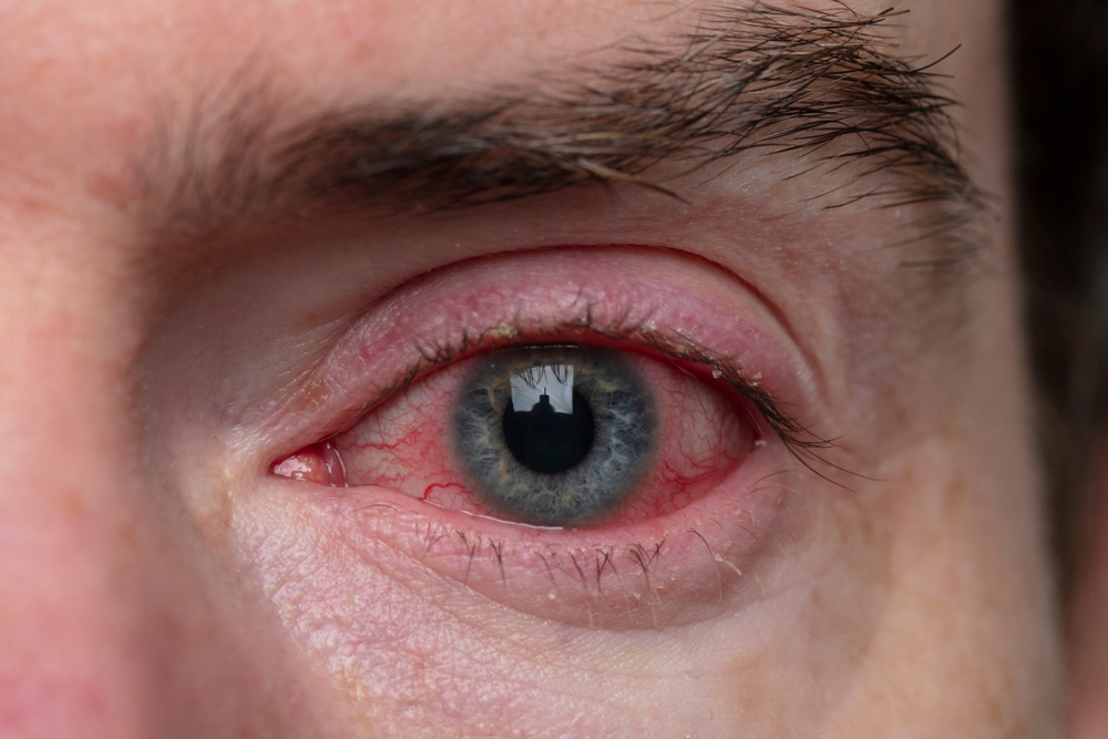 While many people associate skin sores and dental problems as the most common of these manifestations, methamphetamine eyes are another clear sign that someone is taking meth.